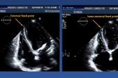 Better Hemodynamics, Less Mismatch With Self-Expanding TAVR vs Surgery